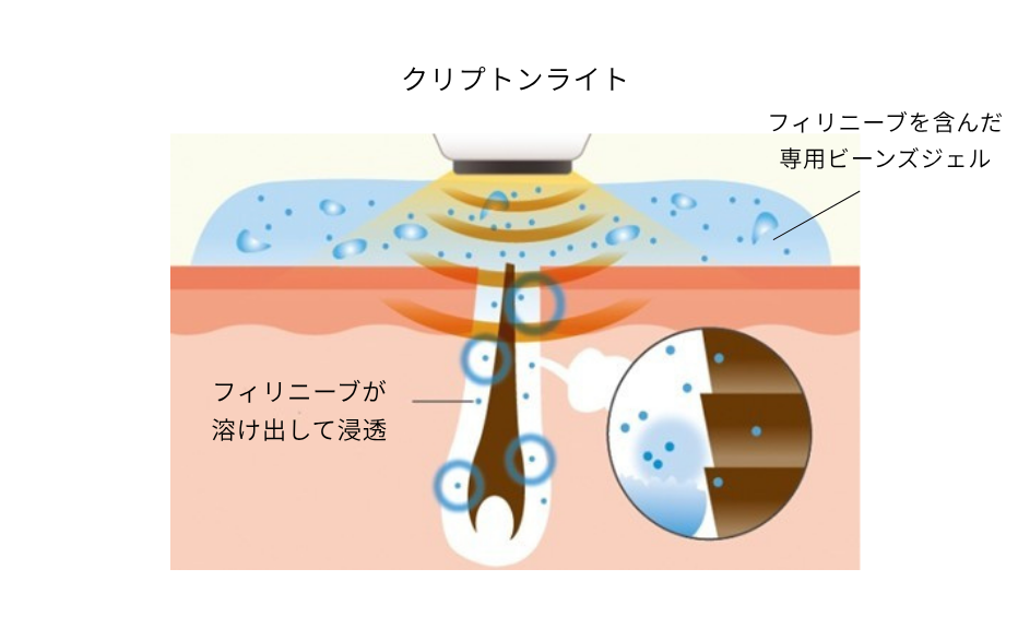 ソワンローズの脱毛の仕組み